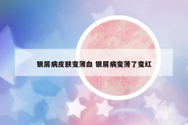 銀屑病皮膚變薄血 銀屑病變薄了變紅