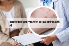 貴陽市銀屑病哪個醫(yī)院好 貴陽去哪看銀屑病好
