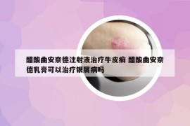 醋酸曲安奈德注射液治療牛皮癬 醋酸曲安奈德乳膏可以治療銀屑病嗎