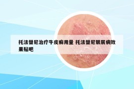 托法替尼治療牛皮癬用量 托法替尼銀屑病效果貼吧