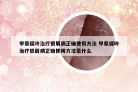 甲氨蝶呤治療銀屑病正確使用方法 甲氨蝶呤治療銀屑病正確使用方法是什么