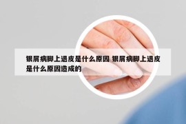 銀屑病腳上退皮是什么原因 銀屑病腳上退皮是什么原因造成的