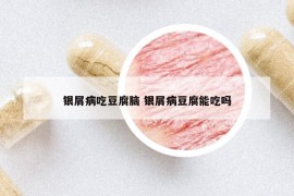 銀屑病吃豆腐腦 銀屑病豆腐能吃嗎