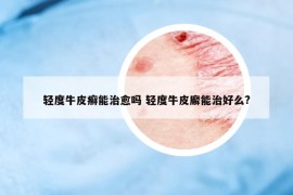 輕度牛皮癬能治愈嗎 輕度牛皮廨能治好么?