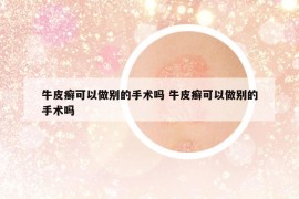 牛皮癬可以做別的手術(shù)嗎 牛皮癬可以做別的手術(shù)嗎
