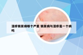 濕疹銀屑病哪個嚴(yán)重 銀屑病與濕疹是一個病嗎