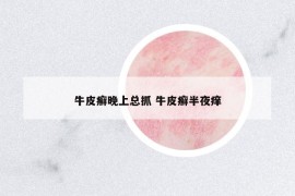 牛皮癬晚上總抓 牛皮癬半夜癢
