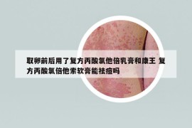 取卵前后用了復(fù)方丙酸氯他倍乳膏和康王 復(fù)方丙酸氯倍他索軟膏能祛痘嗎