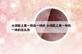 小孩臉上黑一塊白一塊的 小孩臉上黑一塊白一塊的怎么辦