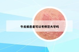 牛皮癬患者可以考師范大學(xué)嗎