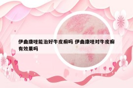 伊曲康唑能治好牛皮癬嗎 伊曲康唑?qū)εＦぐ_有效果嗎