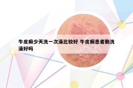 牛皮癬少天洗一次澡比較好 牛皮癬患者勤洗澡好嗎