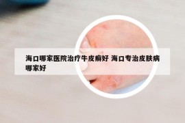 ?？谀募裔t(yī)院治療牛皮癬好 ?？趯Ｖ纹つw病哪家好