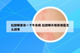 肚臍眼里有一個(gè)牛皮癬 肚臍眼長銀屑病是怎么回事