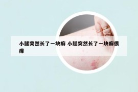 小腿突然長(zhǎng)了一塊癬 小腿突然長(zhǎng)了一塊癬很癢