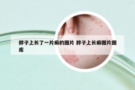 脖子上長了一片癬的圖片 脖子上長癬圖片圖庫