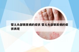 嬰兒頭部銀屑病的癥狀 嬰兒頭部銀屑病的癥狀表現(xiàn)