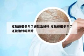 皮膚癬很多年了還能治好嗎 皮膚癬很多年了還能治好嗎圖片
