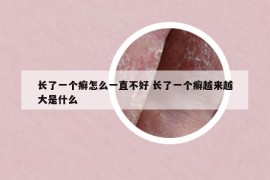 長了一個癬怎么一直不好 長了一個癬越來越大是什么