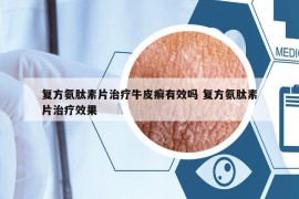 復(fù)方氨肽素片治療牛皮癬有效嗎 復(fù)方氨肽素片治療效果