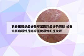 長春銀屑病最好是哪家醫(yī)院最好的醫(yī)院 長春銀屑病最好是哪家醫(yī)院最好的醫(yī)院呢