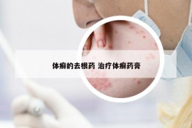 體癬的去根藥 治療體癬藥膏