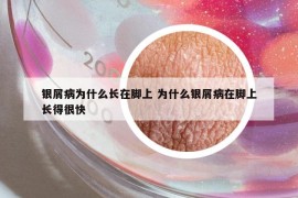 銀屑病為什么長在腳上 為什么銀屑病在腳上長得很快