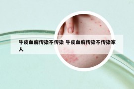 牛皮血癬傳染不傳染 牛皮血癬傳染不傳染家人