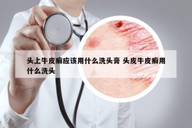 頭上牛皮癬應(yīng)該用什么洗頭膏 頭皮牛皮癬用什么洗頭