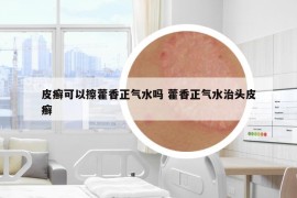 皮癬可以擦藿香正氣水嗎 藿香正氣水治頭皮癬