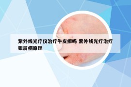 紫外線光療儀治療牛皮癬嗎 紫外線光療治療銀屑病原理