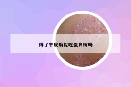 得了牛皮癬能吃蛋白粉嗎
