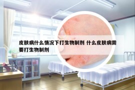皮膚病什么情況下打生物制劑 什么皮膚病需要打生物制劑