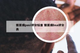 銀屑病pasi評(píng)分標(biāo)準(zhǔn) 銀屑病bsa評(píng)分表