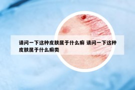 請問一下這種皮膚屬于什么癬 請問一下這種皮膚屬于什么癬類