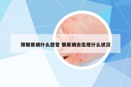 得銀屑病什么感覺 銀屑病會出現(xiàn)什么狀況