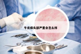 牛皮癬頭部嚴(yán)重會(huì)怎么樣