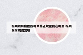 福州銀屑病醫(yī)院哪家最正規(guī)醫(yī)院在哪里 福州銀屑病病友吧