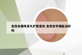 急性白癜風(fēng)多久擴散變快 急性白學(xué)病能治好嗎
