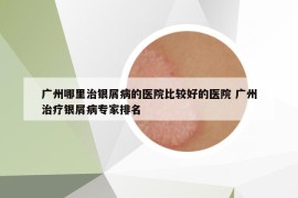 廣州哪里治銀屑病的醫(yī)院比較好的醫(yī)院 廣州治療銀屑病專家排名