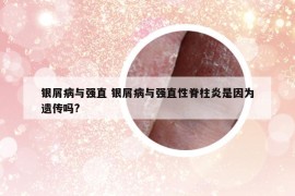 銀屑病與強(qiáng)直 銀屑病與強(qiáng)直性脊柱炎是因?yàn)檫z傳嗎?
