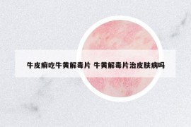 牛皮癬吃牛黃解毒片 牛黃解毒片治皮膚病嗎