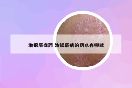 治銀屑癥藥 治銀屑病的藥水有哪些