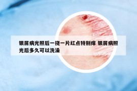 銀屑病光照后一撓一片紅點特別癢 銀屑病照光后多久可以洗澡