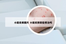 小腿皮癬圖片 小腿皮膚蘚能根治嗎