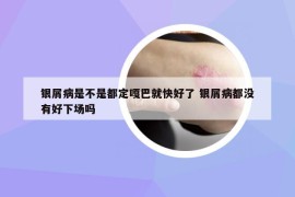 銀屑病是不是都定嘎巴就快好了 銀屑病都沒有好下場嗎