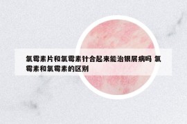 氯霉素片和氯霉素針合起來能治銀屑病嗎 氯霉素和氯霉素的區(qū)別