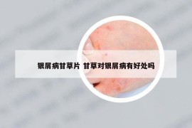 銀屑病甘草片 甘草對(duì)銀屑病有好處嗎