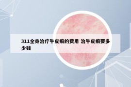 311全身治療牛皮癬的費用 治牛皮癬要多少錢