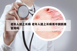 老年人腿上長(zhǎng)癬 老年人腿上長(zhǎng)癬用中國(guó)膚康管用嗎